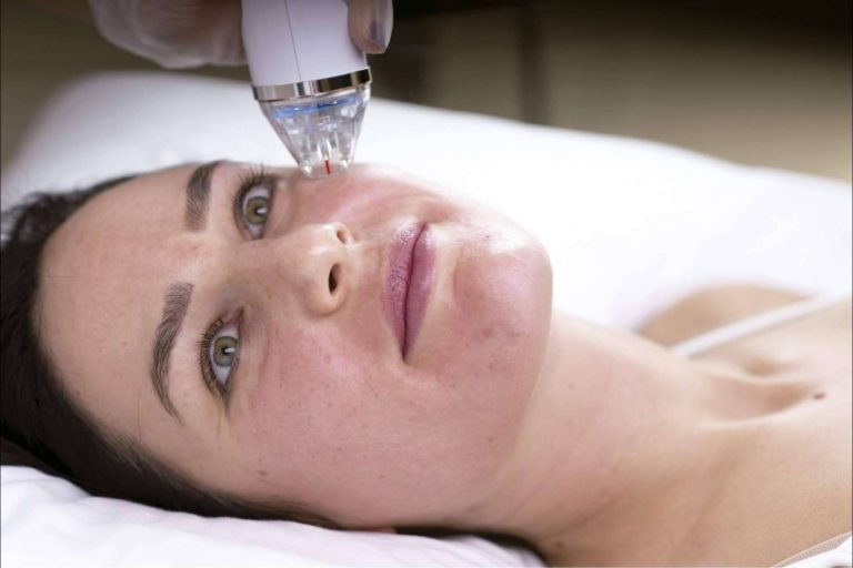 Alluring Clinic y el tratamiento de radiofrecuencia fragmentada con microagujas