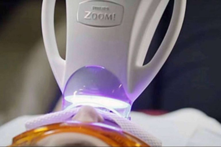 El blanqueamiento dental en casa complementa y mantiene los resultados del procedimiento clínico