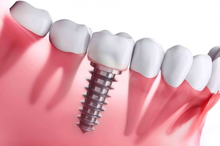 La implantología dental de carga inmediata de Clínica Dental Ahoa