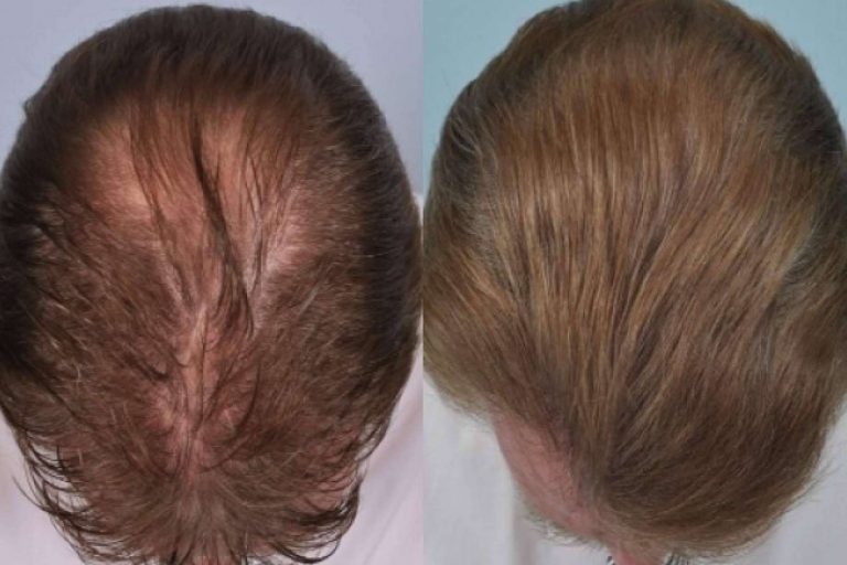 Algunas de las técnicas alternativas al injerto capilar más solicitadas