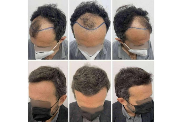 El Dr. Bruno Jacobovski recomienda las vitaminas para la caída de pelo