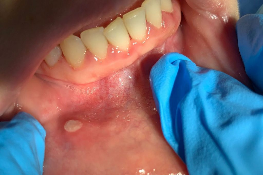 La llagas en la boca que necesita una visita urgente al médico 65 Otras causas