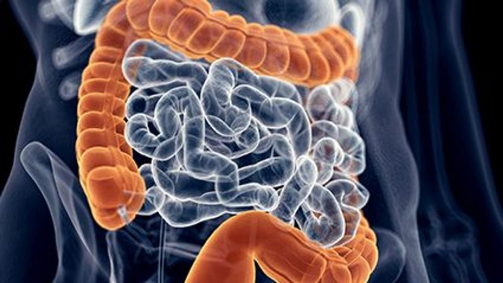 ¿Cuáles son los factores de riesgo del cáncer de colon?