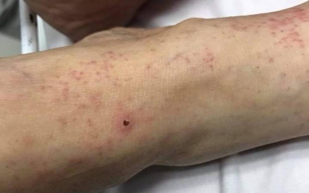 ¿En España hay otras enfermedades que se transmitan por la picadura de una garrapata?