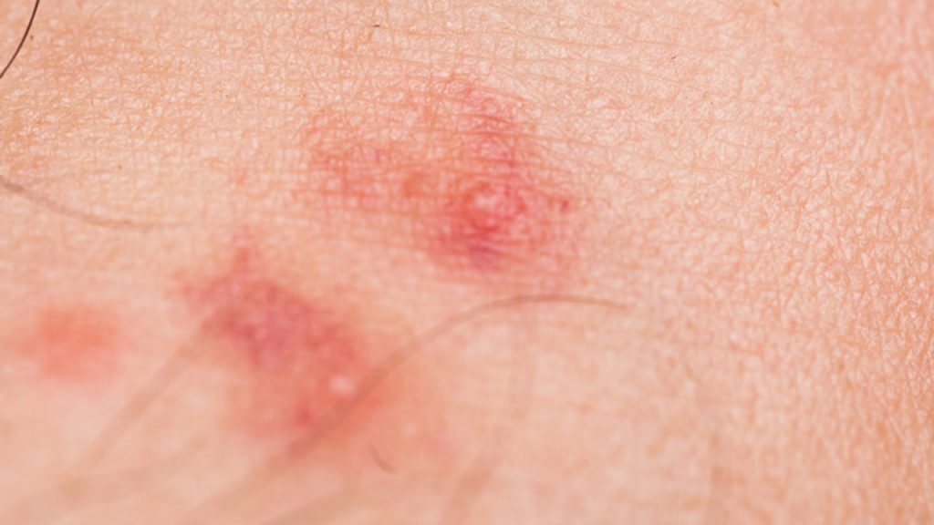 ¿Todas las picaduras de garrapatas son peligrosas?