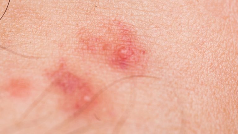 Anecpla alerta: aumentan las garrapatas en perros y mosquitos transmisores de enfermedades: así proteges a tu mascota