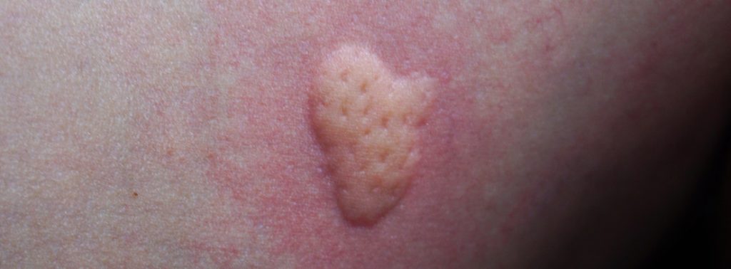 ¿Cómo se logra retirar una garrapata tras picar?