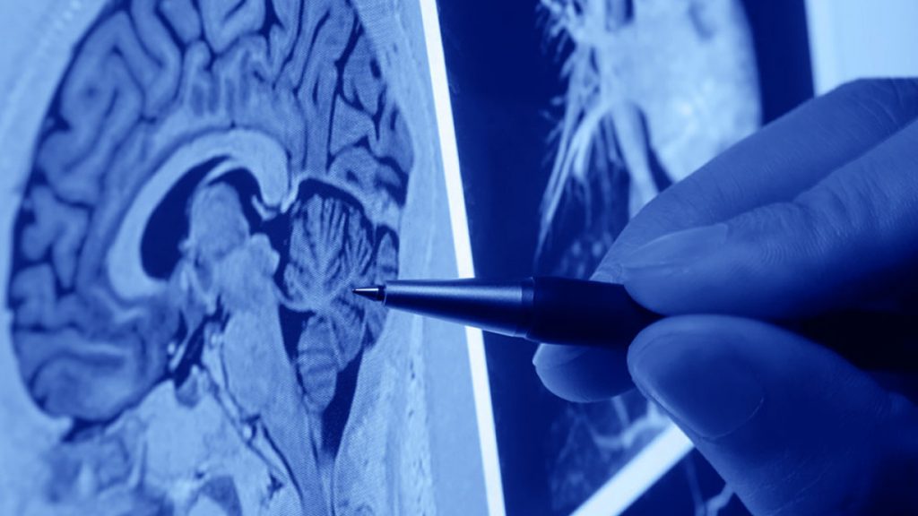 Qué es la adipsia 1 ¿Adipsia una afección rara?