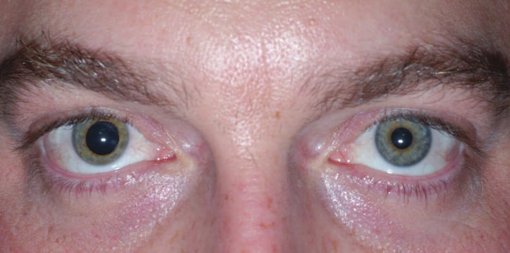 ¿Qué es la anisocoria según la medicina?