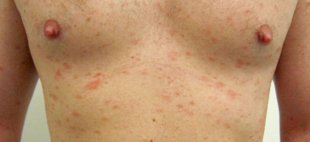 ¿Qué es la pitiriasis rosada?