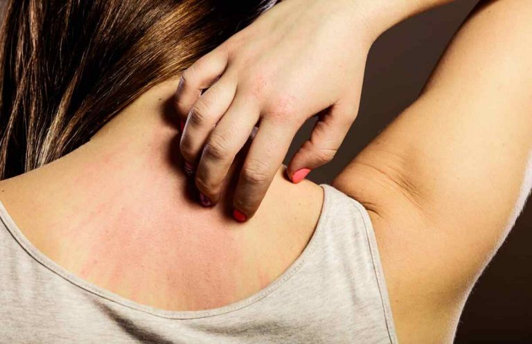 Dermatitis atópica por sudor: causas, tratamiento y prevención