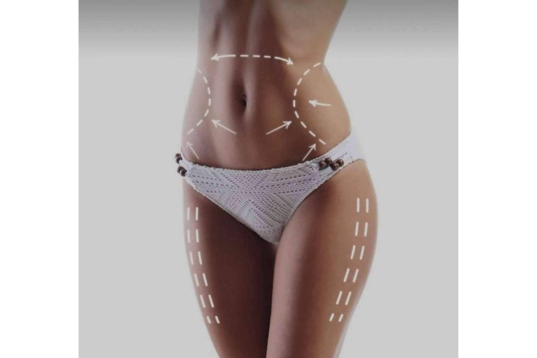 Tratamiento de grasa localizada y celulitis en la clínica de la Dra. Sánchez-Peral, mesoterapia corporal