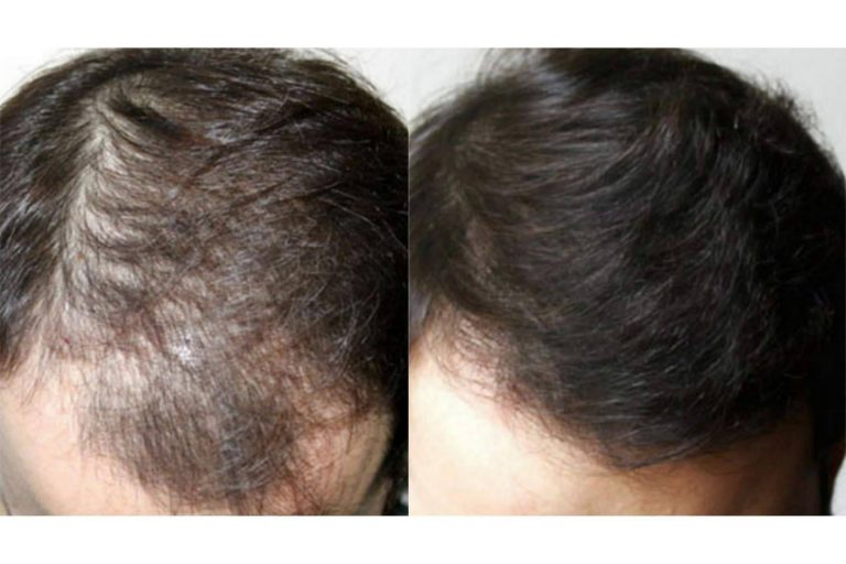 Tratamientos efectivos para alopecia androgenética en la clínica capilar Innovación Capilar