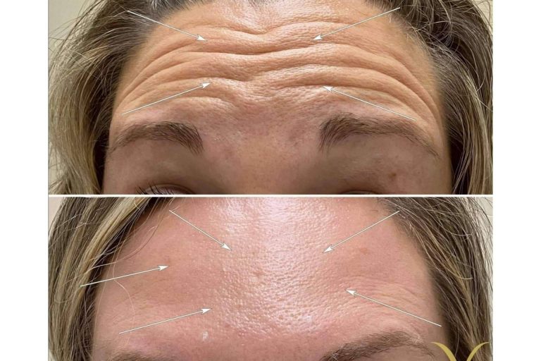 El tratamiento ideal para reducir las arrugas de la frente, entrecejo y patas de gallo es el bótox