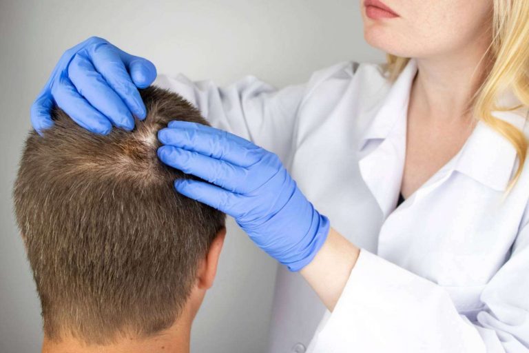 ¿Cuáles son los diferentes tipos de alopecia?, por la Clínica Capilar Laura Agrelo