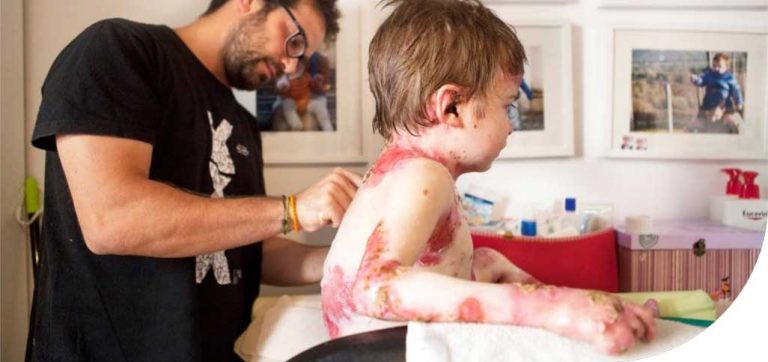 La enfermedad de la “Piel de Mariposa”, la oruga que no concluyó su metamorfosis