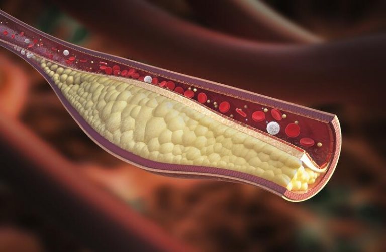Un 25% de españoles repite evento cardiovascular aterosclerótico en los primeros dos años, según un estudio