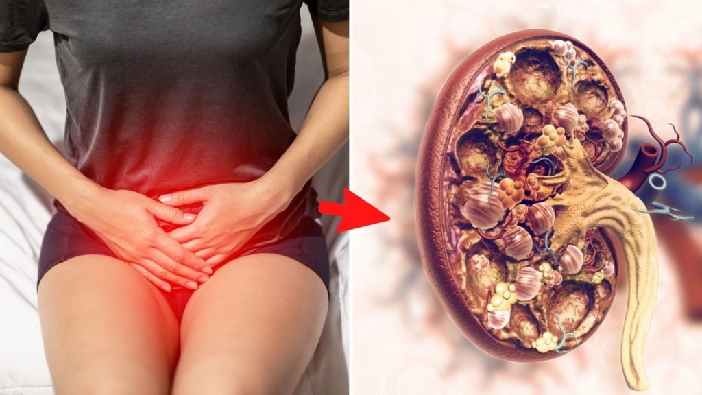 Presencia de sangre en la orina señal de infección de orina