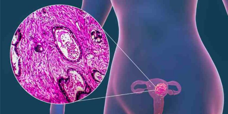 Cáncer de endometrio: señales que te avisan de que debes ir al médico
