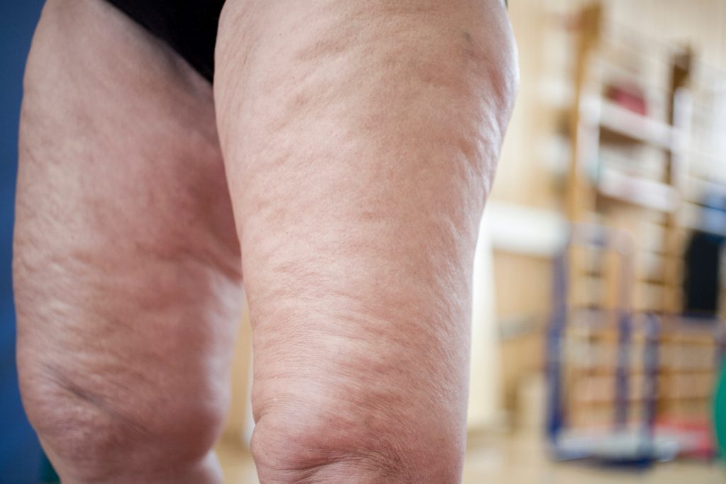 ¿Se puede quemar la grasa de las piernas?