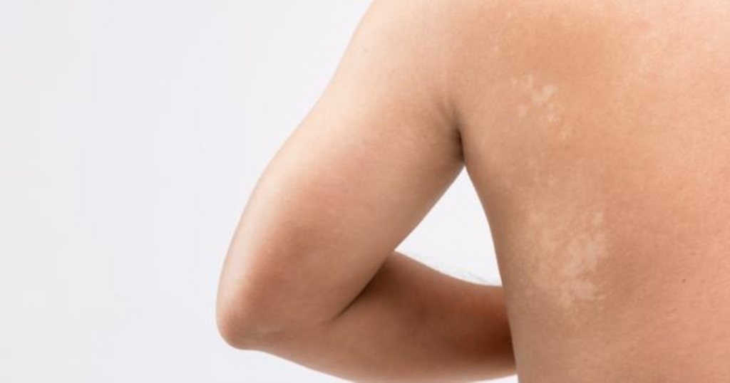 Los terribles hongos