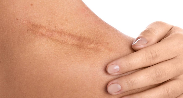 Borra cicatrices remedios caseros