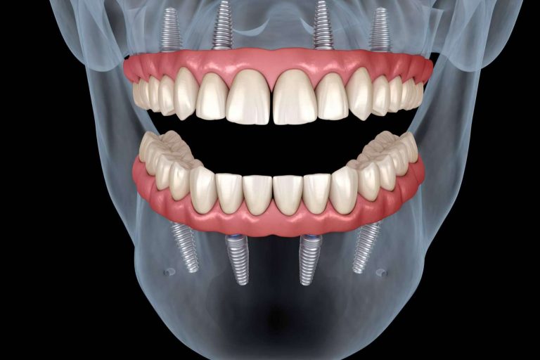 Precisión Médica Dental proporciona los instrumentos para la óptima confección de las prótesis dentales