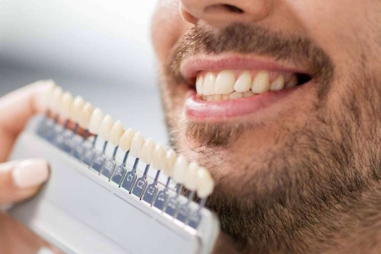 Las carillas dentales ayudan a recuperar la estética de la sonrisa en un día