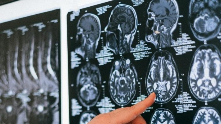 Desarrollan una inteligencia artificial que puede detectar el Parkinson con los patrones de respiración
