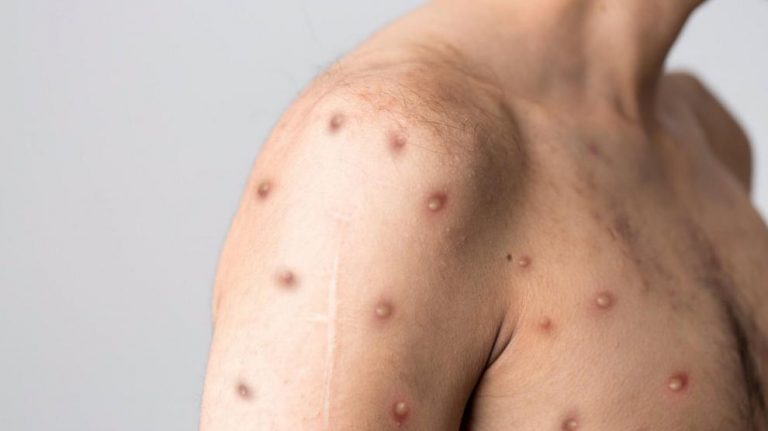 España supera los 5.000 casos de viruela del mono, según Sanidad