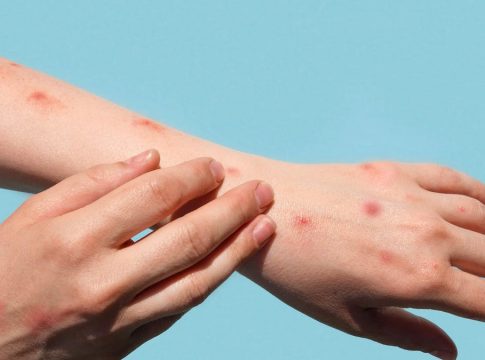 Así se contagia la viruela del mono 1 Así se contagia la viruela del mono