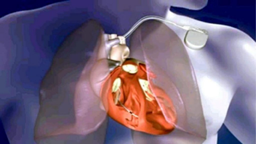 ¿Qué características suele tener un tumor en el corazón?