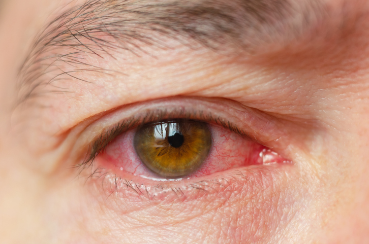 En caso de conjuntivitis, la miel es la mejor opción