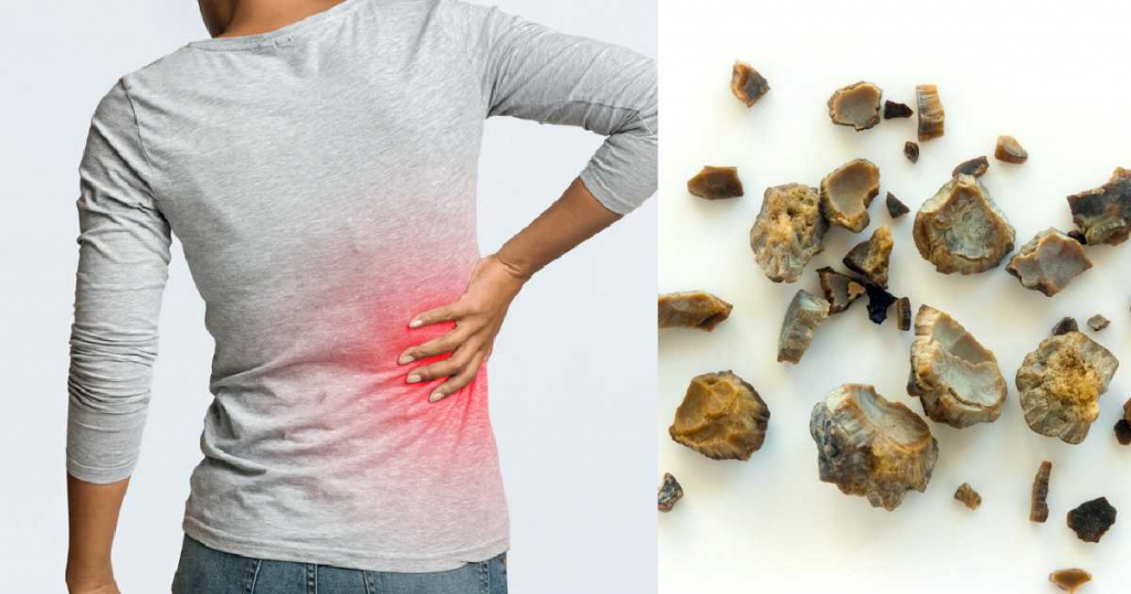 Los cálculos renales