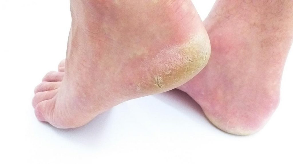 El calzado también puede afectar a tus talones