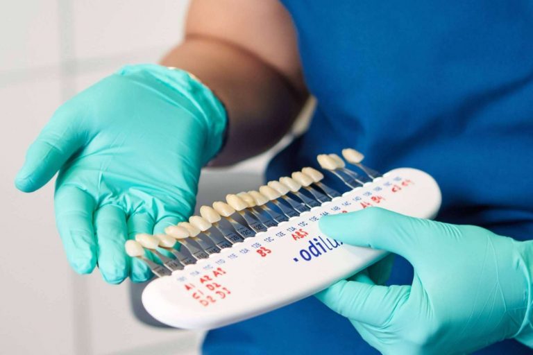 El tratamiento estético dental por excelencia, las carillas dentales