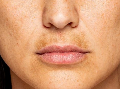melasma manchas manchas solares