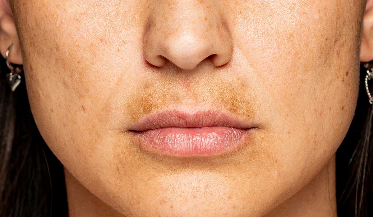 melasma manchas manchas solares