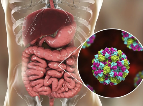 que es la gastroenteritis
