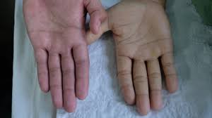 Señales que te avisan de que tienes anemia