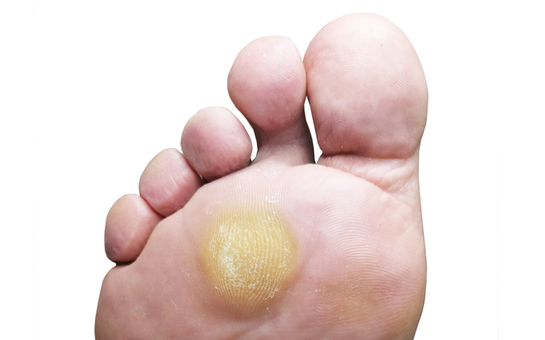 Ampollas en los pies: el truco para borrarlas en 24 horas