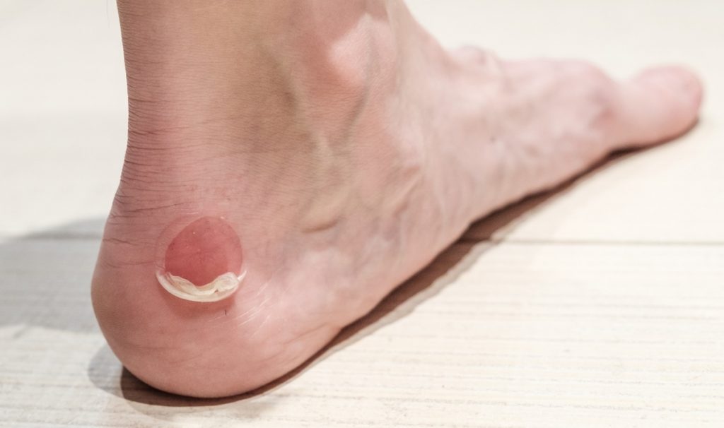 ¿Qué es son las ampollas?