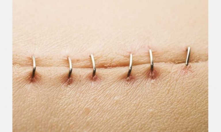 Así debes cuidar una herida si te han dejado puntos