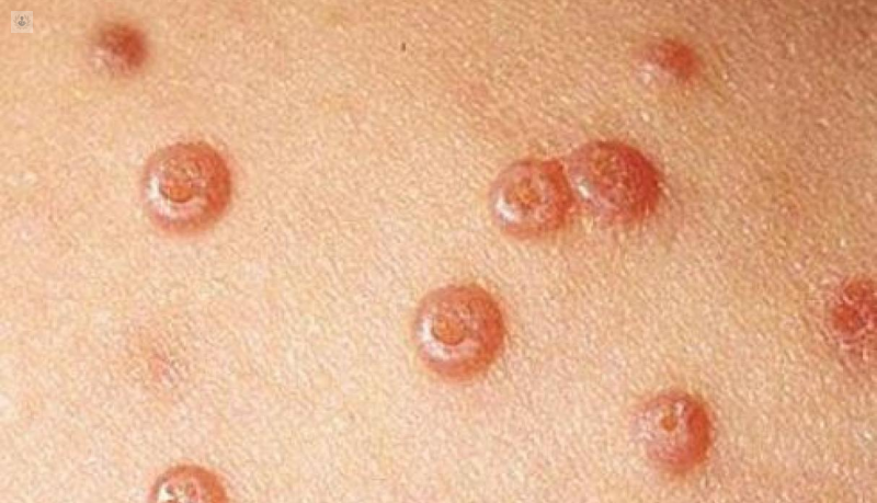 Así se transmiten las verrugas