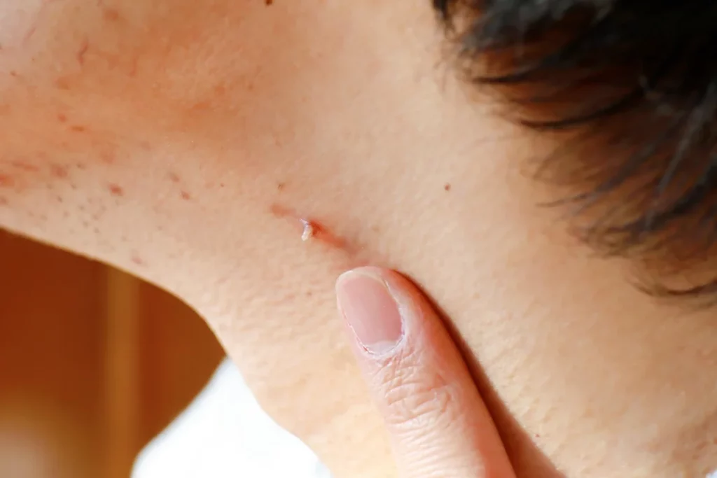 La crioterapia para acabar con las verrugas