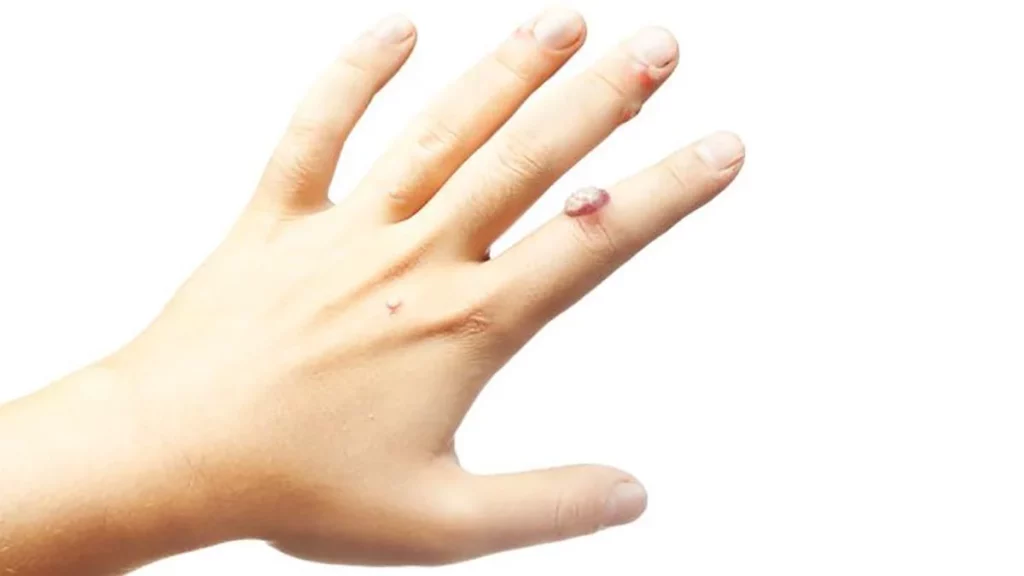 Las verrugas de por sí no son grandes 