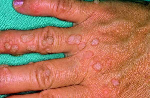 No todas las verrugas son inofensivas 