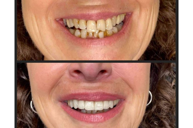 Dentinova explica cómo se previene el sangrado de encías