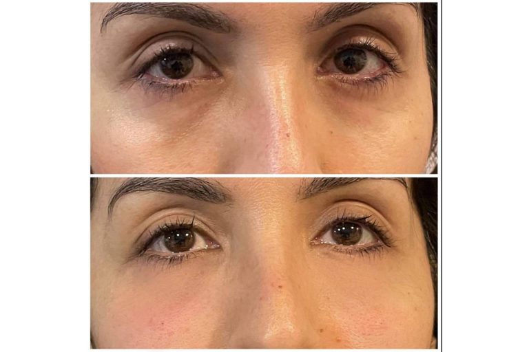 Despertar la mirada de la mano de Cecilia Arthur y su tratamiento de relleno de ojeras con ácido hialurónico