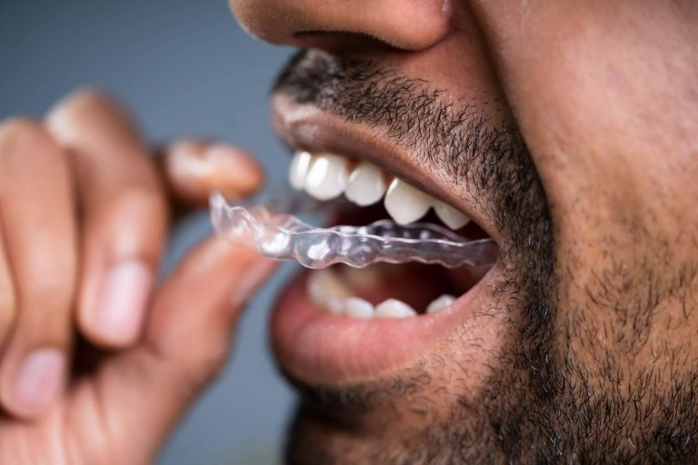 Clínicas Dental Bell habla sobre las ventajas de la ortodoncia invisible